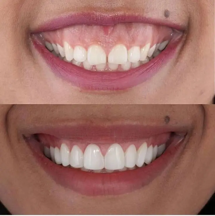 نمونه طرح لبخند اصلاح شده با دندانپزشکی زیبایی
